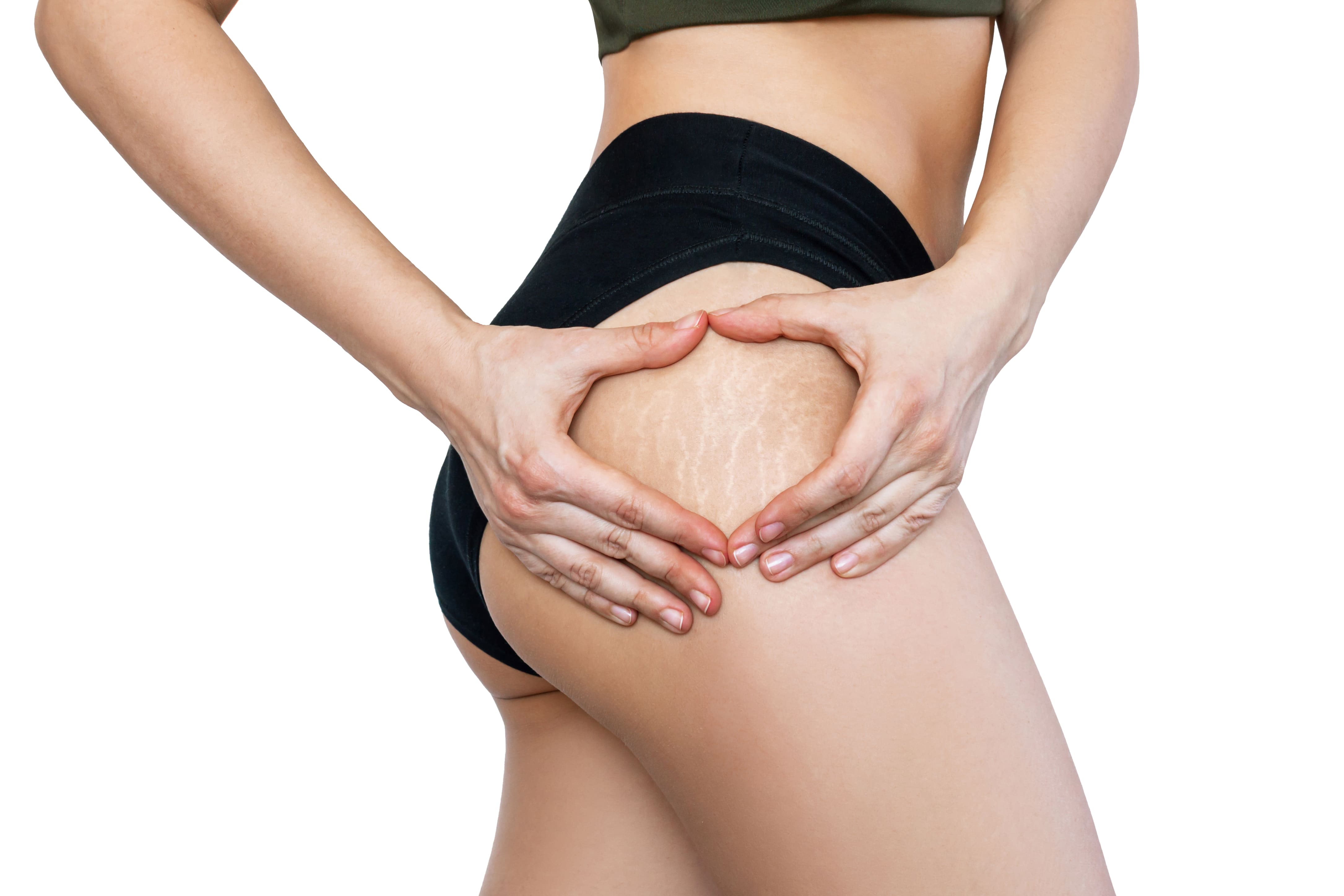donna smagliature glutei e fianchi